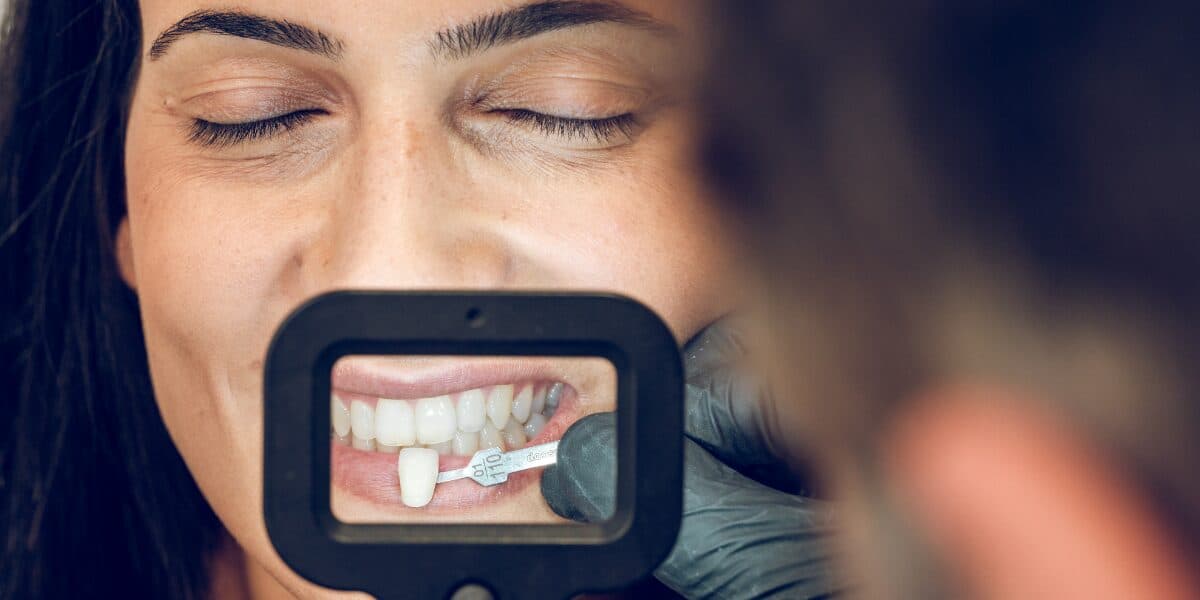 Featured image for the article: 5 Proven Techniques for Veneer Care