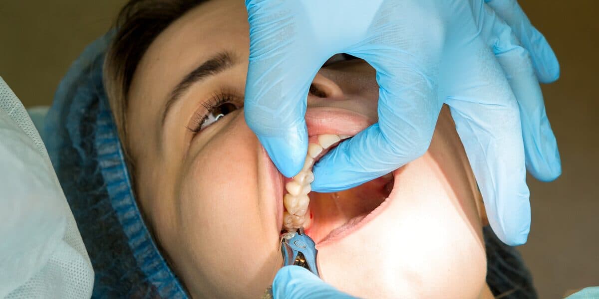 Featured image for the article: What to Consider Before Having Your Wisdom Tooth Removed
