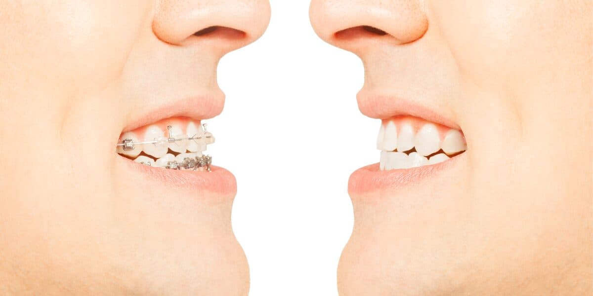 Featured image for the article: Braces vs. Clear Aligners: Which Option is Right for You?