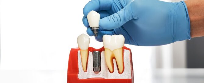 dental implants