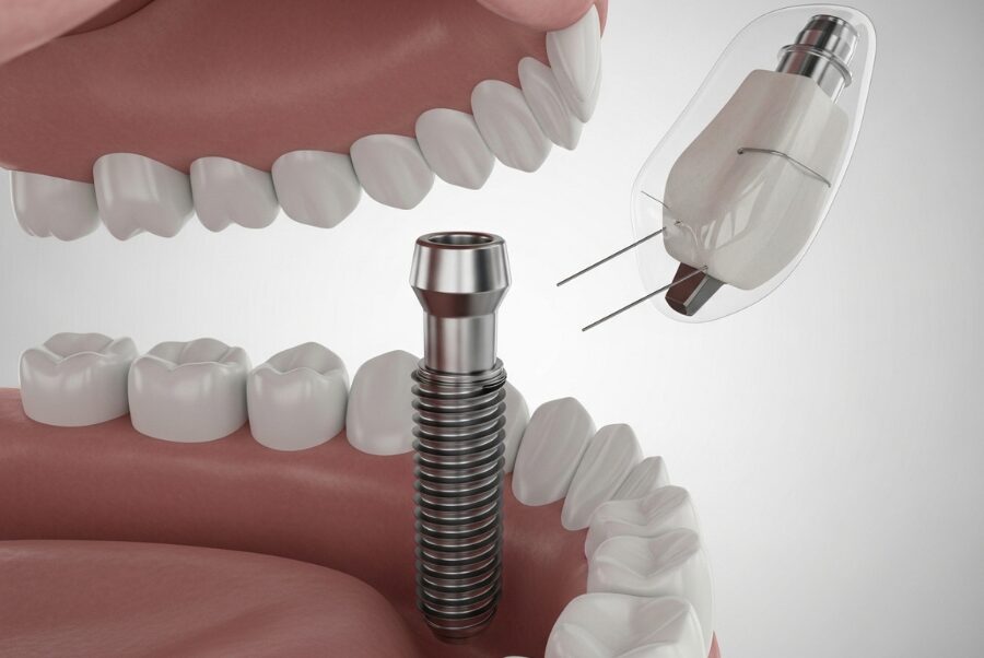 dental implant placement surgery titanium post jaw Woodbridge VA
